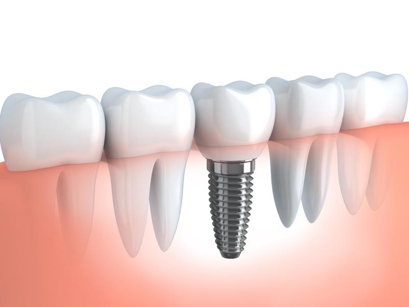 Dental Implants  Cerritos, CA 