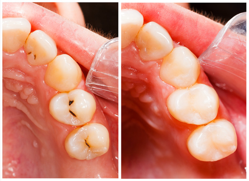 Fillings  Cerritos, CA 