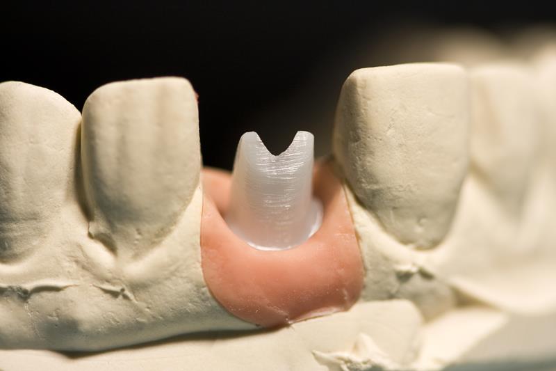 Implant Restoration  Cerritos, CA 
