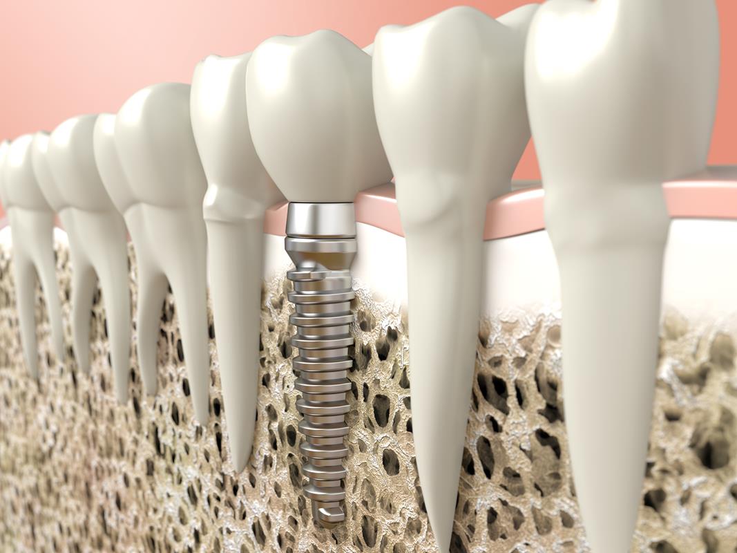 Dental Implants  Cerritos, CA 
