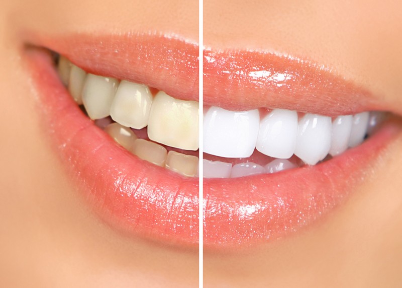 Teeth Whitening  Cerritos, CA 